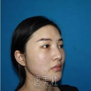张智勇颧骨内推案例|脸型终得改变! width=
