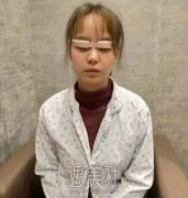 赵延勇做上睑下垂案例|灰暗人生就此结束! width=
