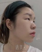 周长兵双眼皮修复案例|精气神瞬间得到改变! width=