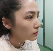 祝联双眼皮修复案例，是我想要的亚子~ width=