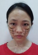 孙玮骏埋线提升案例|果真是惊人! width=