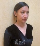 海医悦美林勇隆鼻案例|变美从这里开始! width=
