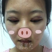 修志夫整形怎么样?有真实的双眼皮案例吗? width=