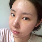 巫文云技术到底好不好?较新隆鼻案例一览~ width=