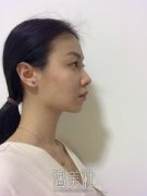 靳小雷做的双眼皮特点：真实双眼皮案例对比~ width=