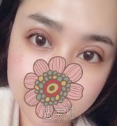 九院周一雄个人资料，知名眼部整形专家双眼皮案例~ width=