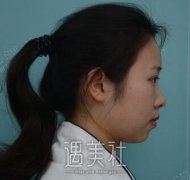 李圣利隆鼻案例分享：自然鼻子大作战~ width=