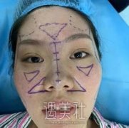 上海九院美容科王炜假体隆鼻案例：内附价格表分享~ width=