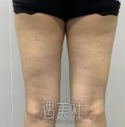 北京八大处吸脂多少钱?大腿吸脂案例价格表2020分享~ width=