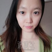 李劲良做鼻子怎么样?真实隆鼻案例果真的很棒哦~ width=
