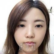 昆医附二院整形科贵么?内附肖鸿真实双眼皮案例对比图分享 width=