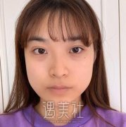 九院韦敏下颌角切除日志分享：颜值小脸up up~ width=