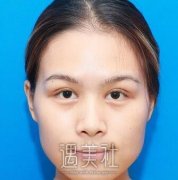 李湘原整形磨骨怎么样?真实磨骨案例对比图来咯 width=