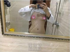 栗勇丰胸案例？一味用自体脂肪隆胸只会增加胸下垂~ width=