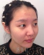 杨丽双眼皮案例分享：劝大家不要去做做完以后就是这个亚子 width=