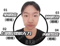 青岛伊美尔单文涛5s重睑术+超微创开内眦案例~ width=