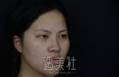 林登文割双眼皮怎么样|说再多不如看案例对比图~ width=