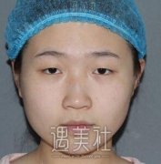 佳木斯美白医院双眼皮案例恢复过程对比图分享~ width=