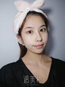 王佳琦双眼皮案例：有没有失败帮看看恢复图~ width=