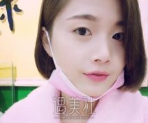 中山三院颜玲双眼皮案例分享|恢复得不错~ width=