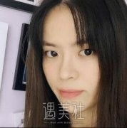 济南割双眼皮薛峰医生怎么样?案例恢复过程分享~ width=