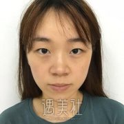 北医三院薛红宇双眼皮案例分享：我觉得不怎么自然~ width=