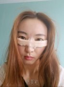 去眼袋上海九院整容失败案例，果看看才知道~ width=