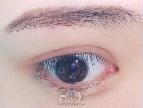 芭比双眼皮