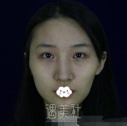 下颌角加颧骨内推案例：术后两个月全记录附照片 width=