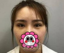 刘风卓三眼皮修复案例：较为漂亮很自然 width=