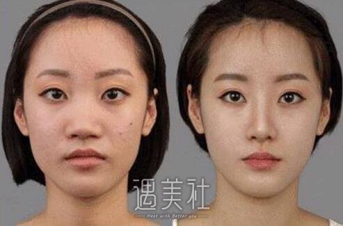 硅胶隆鼻