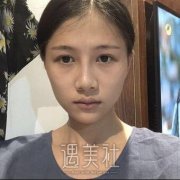 八大处王克明隆鼻案例：前后对比图分享~ width=