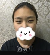 吉大一院二部董雪双眼皮案例|前后恢复对比~ width=