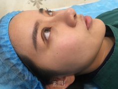 八大处陈文双眼皮案例：真实案例摆在眼前~ width=