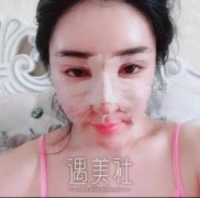 南京李俊隆鼻案例|前后恢复对比分享~ width=