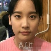 张余光双眼皮修复案例图 三个月后果展示 width=