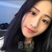 张霞飞双眼皮价格|内有案例分享哦~ width=