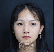钱文江双眼皮案例：手术前后恢复过程~ width=