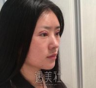 武汉协和孙家明双眼皮案例|前后恢复过程~ width=