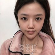 丹东富雅华医割双眼皮怎么样?内有案例对比图~ width=