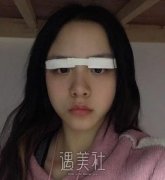 西京医院孙峰失败案例：双眼皮恢复照片分享~ width=