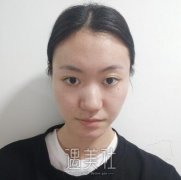 成都华人医联失败案例：塌鼻子改造大变化~ width=