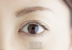 沈莺莺双眼皮修复案例:变化是较为大的 width=
