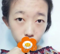 祁佐良双眼皮案例：差距真的是太大 width=