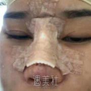 周柯做肋软骨隆鼻怎样?案例看出大问题~ width=