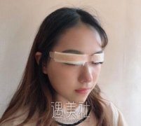 周长兵双眼皮案例：真实案例果对比~ width=