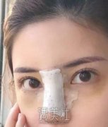 南京天熙整形失败案例?隆鼻前后对比~ width=