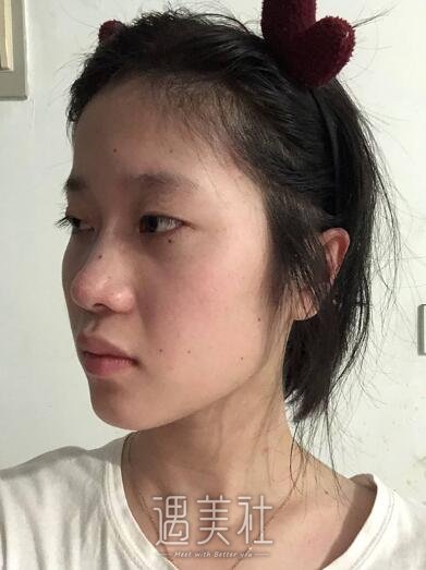 遇美社 整形日记 > 八大处郭鑫失败案例:双眼皮效果恢复对比