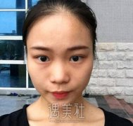 北医三院安阳隆鼻技术怎么样?有失败案例吗? width=