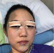 沈阳伊美尔双眼皮整形技术怎么样?有失败案例吗? width=
